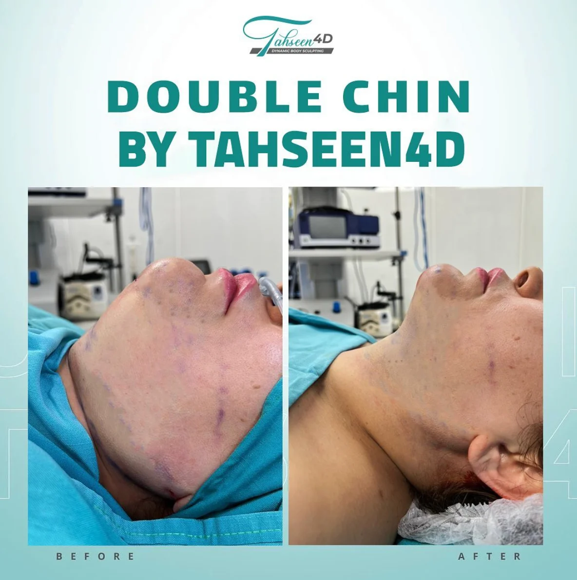Double chin before and after campaign created for Tahseen 4D